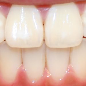 Teeth after dental procedure - tribeca dental care