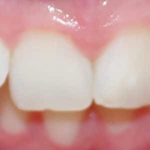 Teeth before dental procedure - tribeca dental care