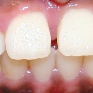 Teeth before dental procedure - tribeca dental care