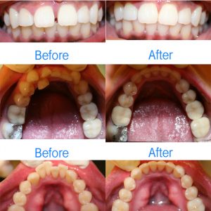 BEFORE AFTER COLLAGE - tribeca dental care