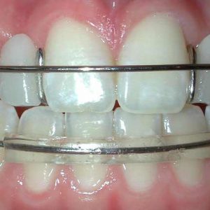 Hawley Retainer