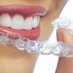 what is Invisalign