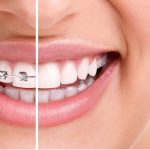 invisalign_benefits