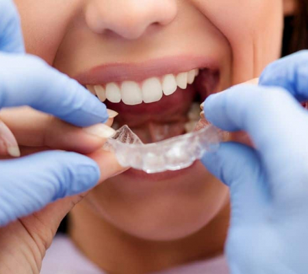 Is Byte better than Invisalign?